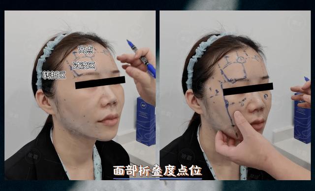 轮廓固定是什么医美项目做的，轮廓固定是什么医美项目做的好？
