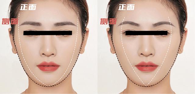 轮廓固定是什么医美项目做的，轮廓固定是什么医美项目做的好？